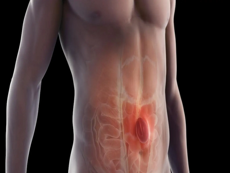 abdominal hernia
