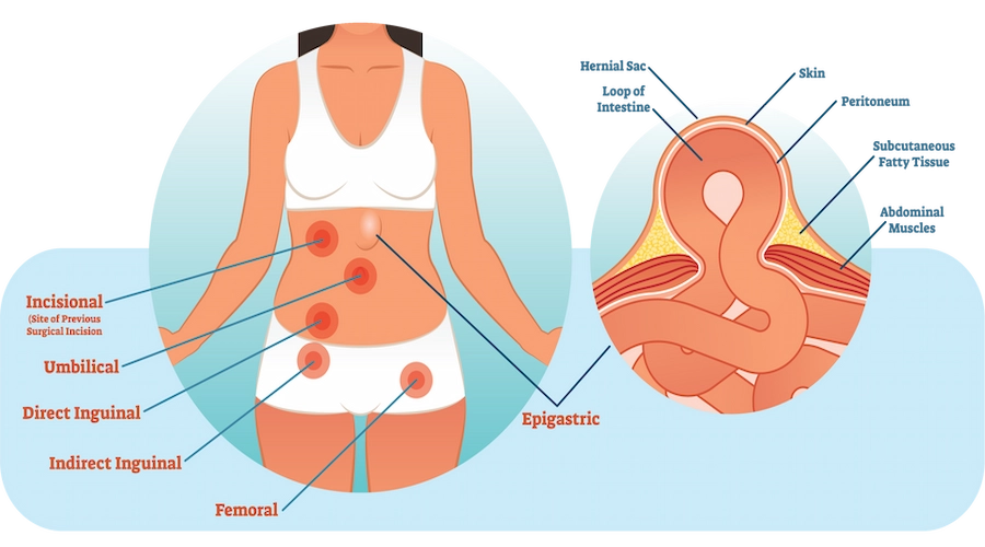 abdominal hernia