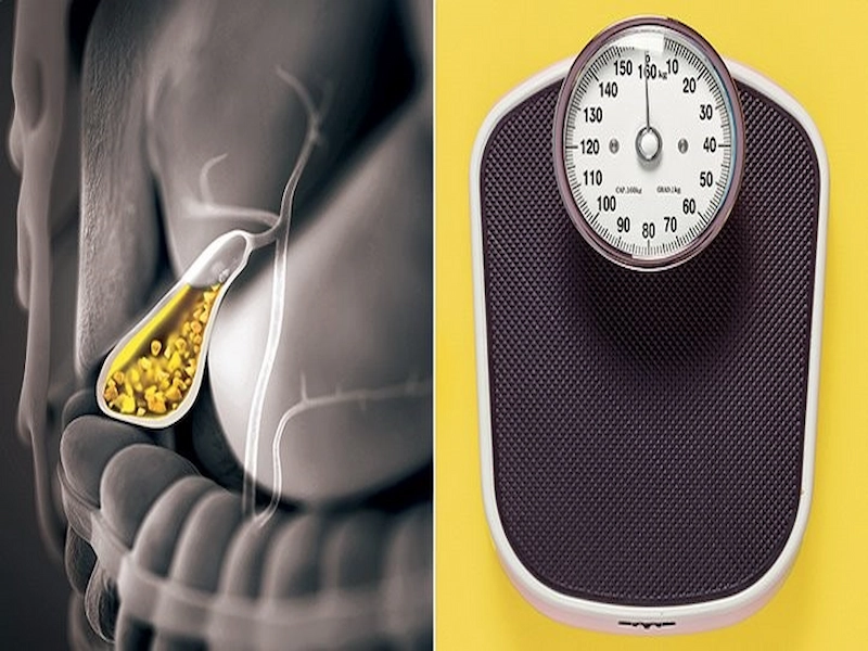 gallstones and obesity