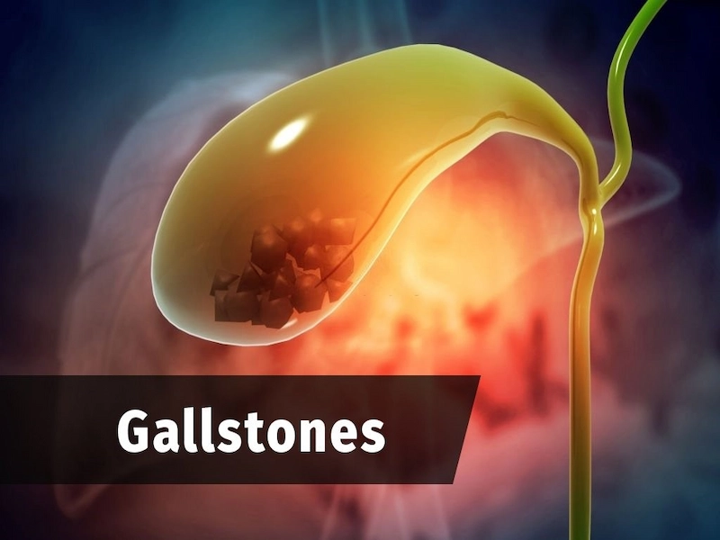 gallstones and obesity