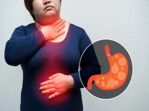 relationship between obesity and acid reflux