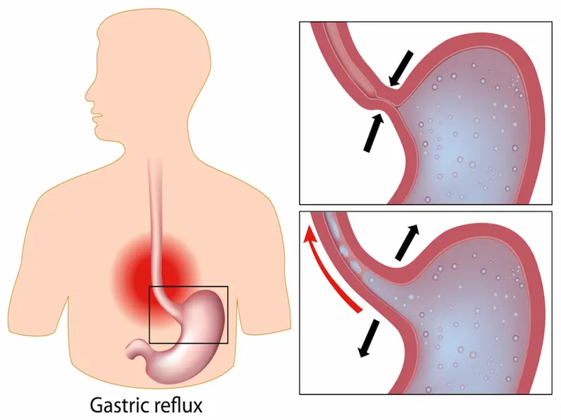 What is gastric reflux