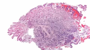 Gastrointestinal neuroendocrine tumors