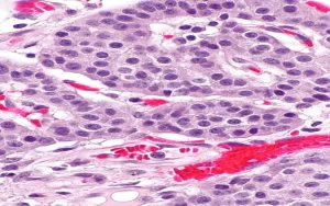 pancreatic neuroendocrine tumors in patients with MEN 1