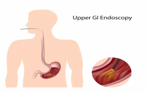 Upper gastrointestinal (UGI) endoscopy